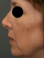 Female Revision Rhinoplasty 