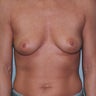 35-Year-Old Female Breast Augmentation