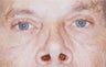 Blepharoplasty