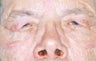 Blepharoplasty