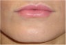 Lip Augmentation