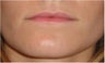 Lip Augmentation