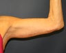 Arm-Lift  (Brachioplasty)