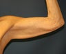 Arm-Lift  (Brachioplasty)