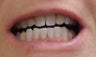 Teeth Whitening Procedure for a Female