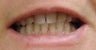 Teeth Whitening Procedure for a Female