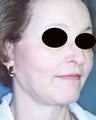 55 year old female patient 