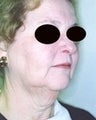 55 year old female patient 