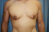 27 years British male gym trainer suffering from male breast enlargement with ptosis for past 2 years
