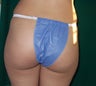Brazilian Butt Lift