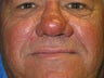 CO2 Fractional Laser