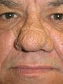 CO2 Fractional Laser