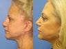 Exilis skin tightening of face and neck