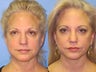 Exilis skin tightening of face and neck