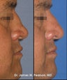 Revision Rhinoplasty / Nasal Surgery