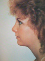 Chin Liposuction 