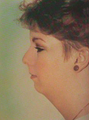 Chin Liposuction 