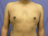 Male Breast Reduction