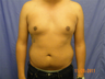 Male Breast Reduction