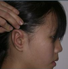 Microtia aka small Ear