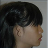Microtia aka small Ear