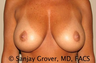 Breast Implant Revision