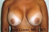 Breast Implant Revision