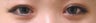 Bilateral Asian Eyelid w/ Inner Corner Surgery