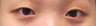 Bilateral Asian Eyelid w/ Inner Corner Surgery