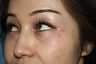 30 years female underwent Restylane filler for lower lid wrinkles