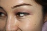 30 years female underwent Restylane filler for lower lid wrinkles
