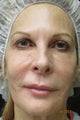 Ultherapy Full Face