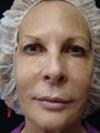 Ultherapy Full Face