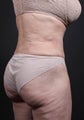 This 65 year old patient underwent liposuction of the lower back and flanks