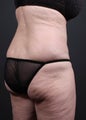 This 65 year old patient underwent liposuction of the lower back and flanks