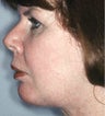 Liposculpture