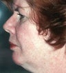 Liposculpture