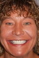 Mouth Reconstruction 47 Year Old Woman