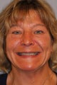 Mouth Reconstruction 47 Year Old Woman