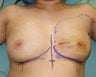 Left Breast Reconstruction after Mastectomy