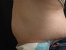 Coolsculpting
