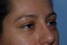 Eyelid Surgery