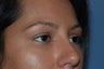 Eyelid Surgery