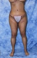 Brazilian Butt Lift