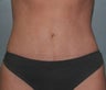 34-Year-Old Female Tummy Tuck