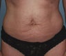 34-Year-Old Female Tummy Tuck