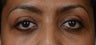 Before and After Lower Eyelid Blepharoplasty