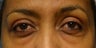 Before and After Lower Eyelid Blepharoplasty