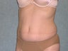 Liposuction