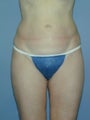 Liposuction